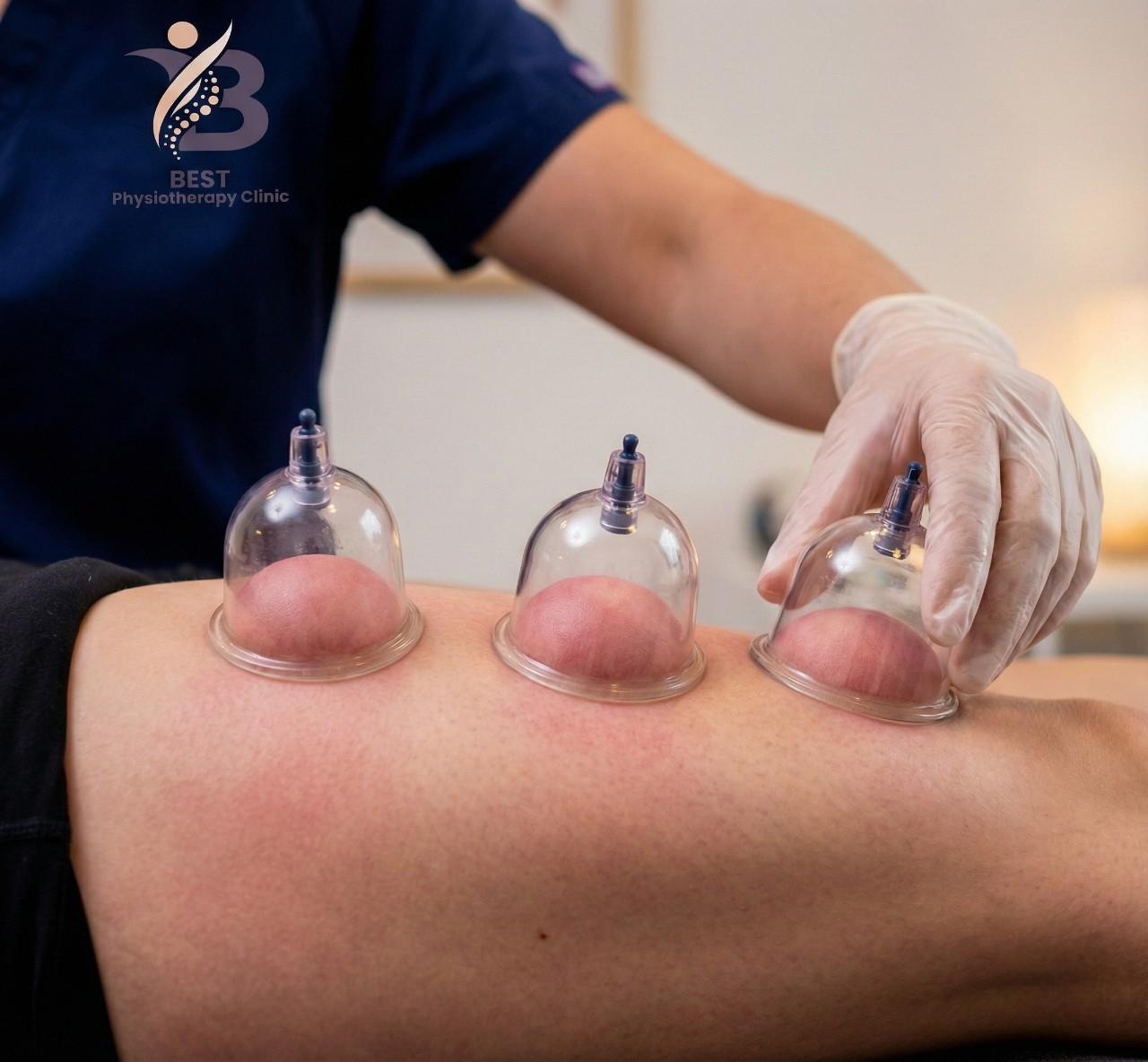 Close-up of vacuum cupping therapy on leg demonstrating myofascial decompression and improved blood circulation.