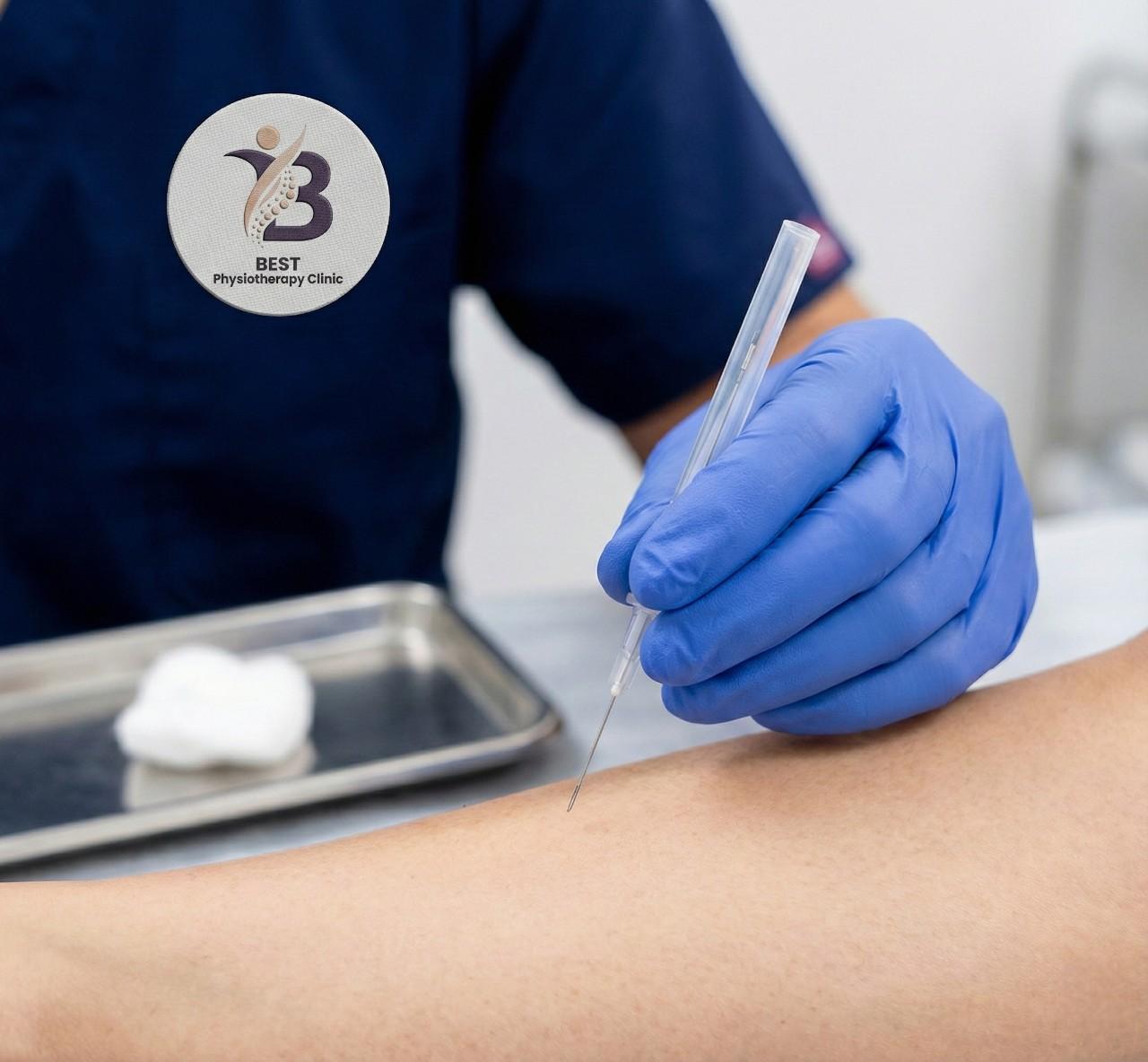 Close-up of a sterile filament needle being inserted for targeted dry needling therapy treatment by a specialist.