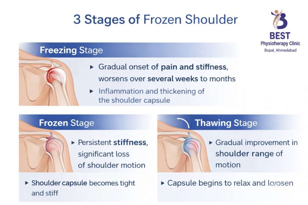 3 stages of frozen shoulder diagram — Best physiotherapy clinic Bopal, Ahmedabad