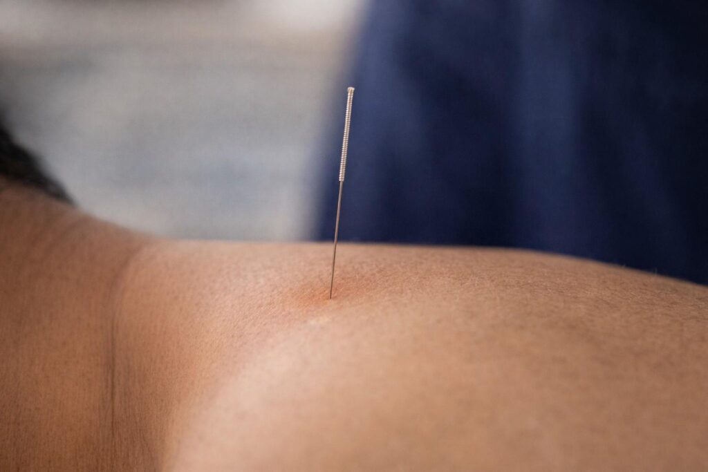Close-up of thin filament needle used in dry needling therapy session